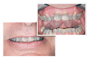 Before Dental Care