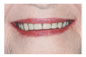 Before Dental Care
