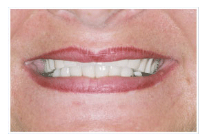 Before Dental Care