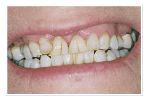 Before Dental Care