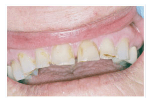 Before Dental Care