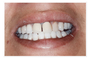 Before Dental Care