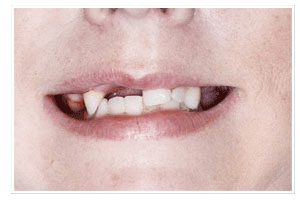 Before Dental Care
