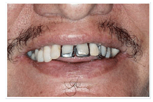 Before Dental Care