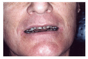 Before Dental Care