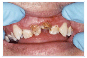 Before Dental Care