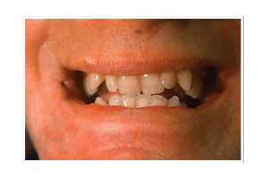Before Dental Care
